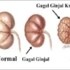 Hipertensi Bisa Berakibat Gagal Ginjal, Ini Penjelasannya