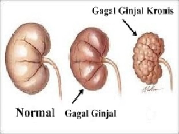 Hipertensi Bisa Berakibat Gagal Ginjal, Ini Penjelasannya