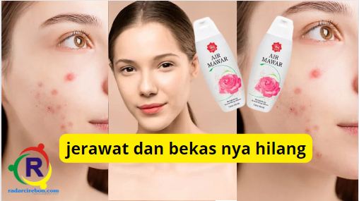 Cara menggunakan air mawar viva untuk jerawat.