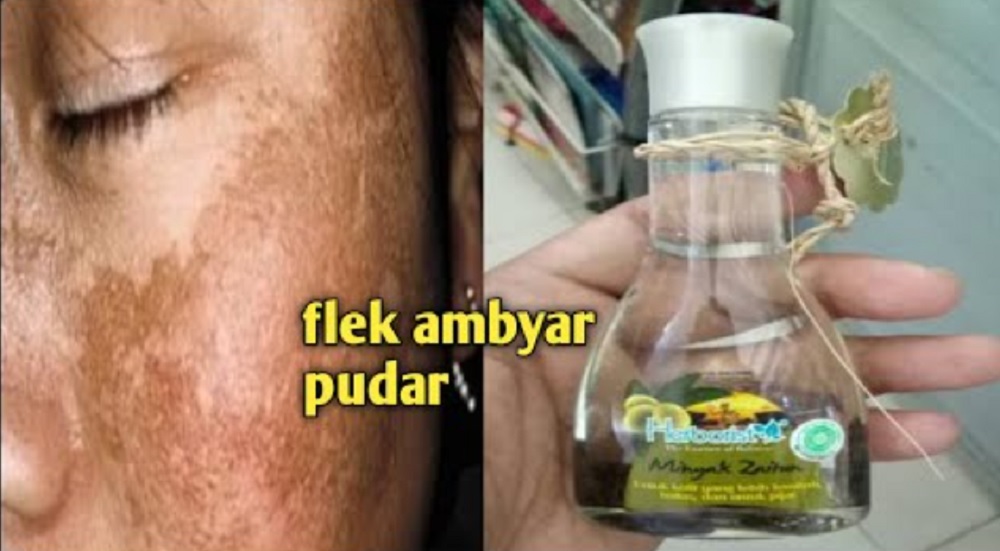Menghilangkan flek hitam dengan minyak zaitun