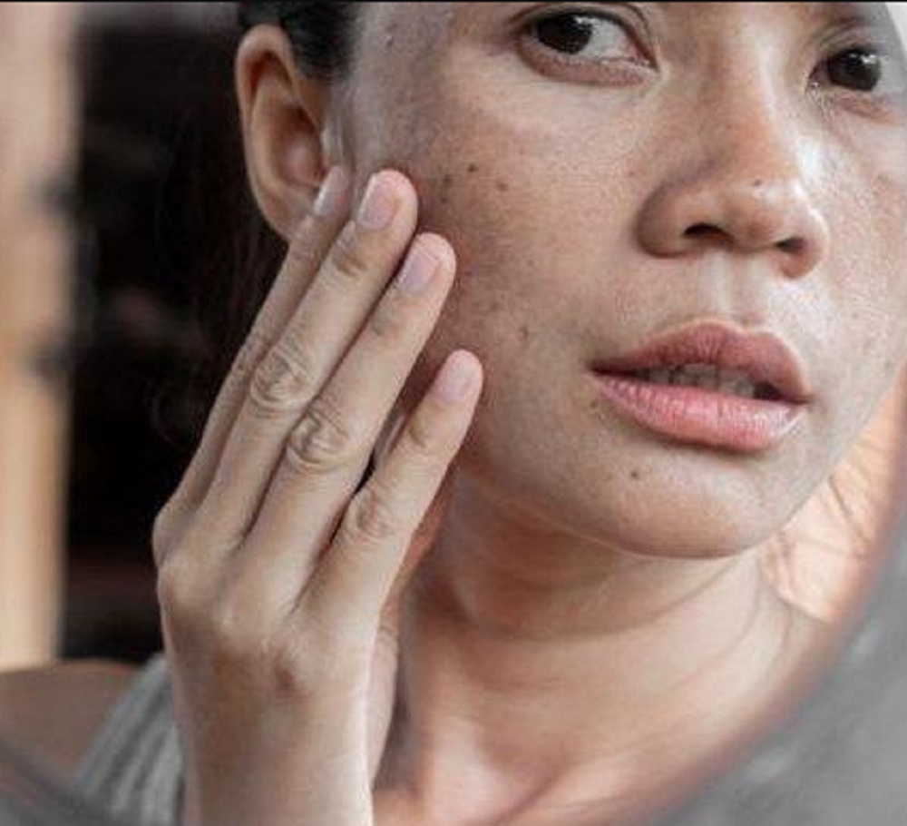 PRAKTIS! Begini Cara Menghilangkan Flek Hitam Dalam 1 Jam, Terbukti