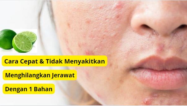 Cara hilangkan jerawat batu dengan jeruk nipis.