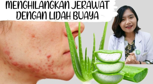 lidah buaya ampuh atasi jerawat