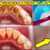 CARA MENGHILANGKAN KARANG GIGI SECARA ALAMI