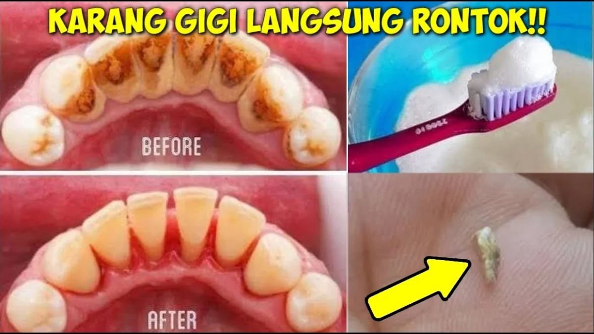 CARA MENGHILANGKAN KARANG GIGI SECARA ALAMI