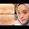 Skincare penghilang bruntusan