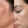 Skincare untuk menghilangkan flek hitam.