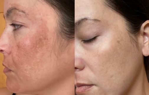 Skincare untuk menghilangkan flek hitam.