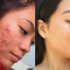 skincare untuk menghilangkan jerawat.