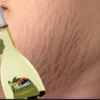 cara mengatasi stretch mark dengan minyak zaitun