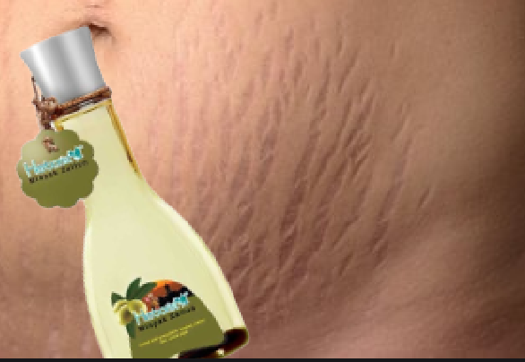 cara mengatasi stretch mark dengan minyak zaitun