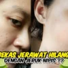 jeruk nipis untuk wajah berjerawat