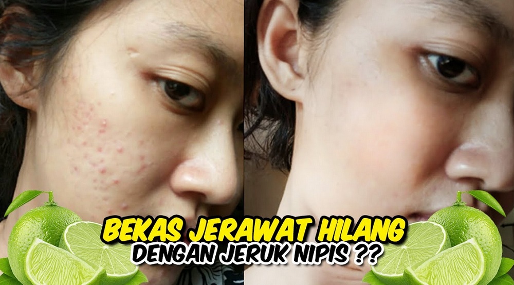 jeruk nipis untuk wajah berjerawat