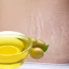 minyak zaitun untuk stretch mark