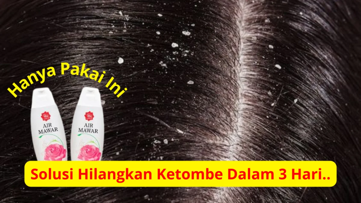 Air mawar untuk ketombe rambut.