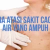 obat cacar air tradisional paling ampuh