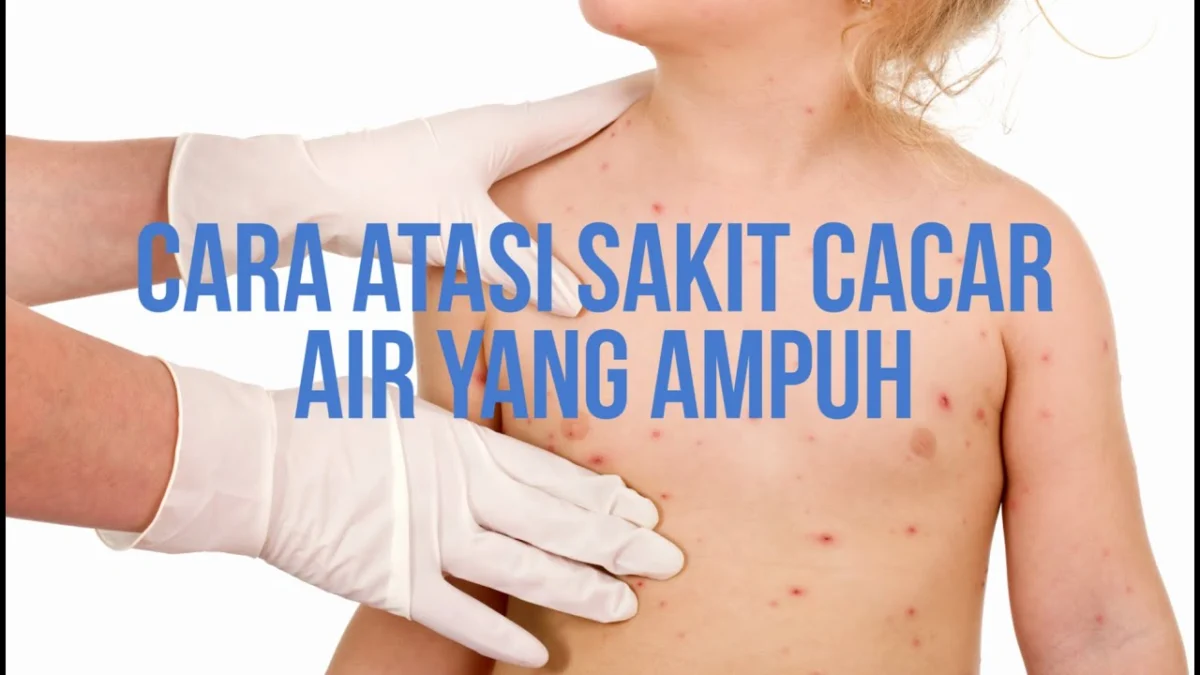 obat cacar air tradisional paling ampuh