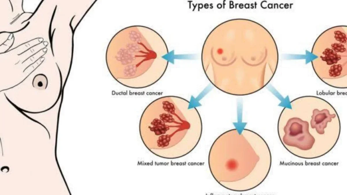 Kenali Ciri-Ciri Serta Letak Benjolan Kanker Payudara Sebelum Semakin Parah!