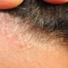 Ketombe atau Dermatitis Seboroik? Ini Cara Membedakannya!