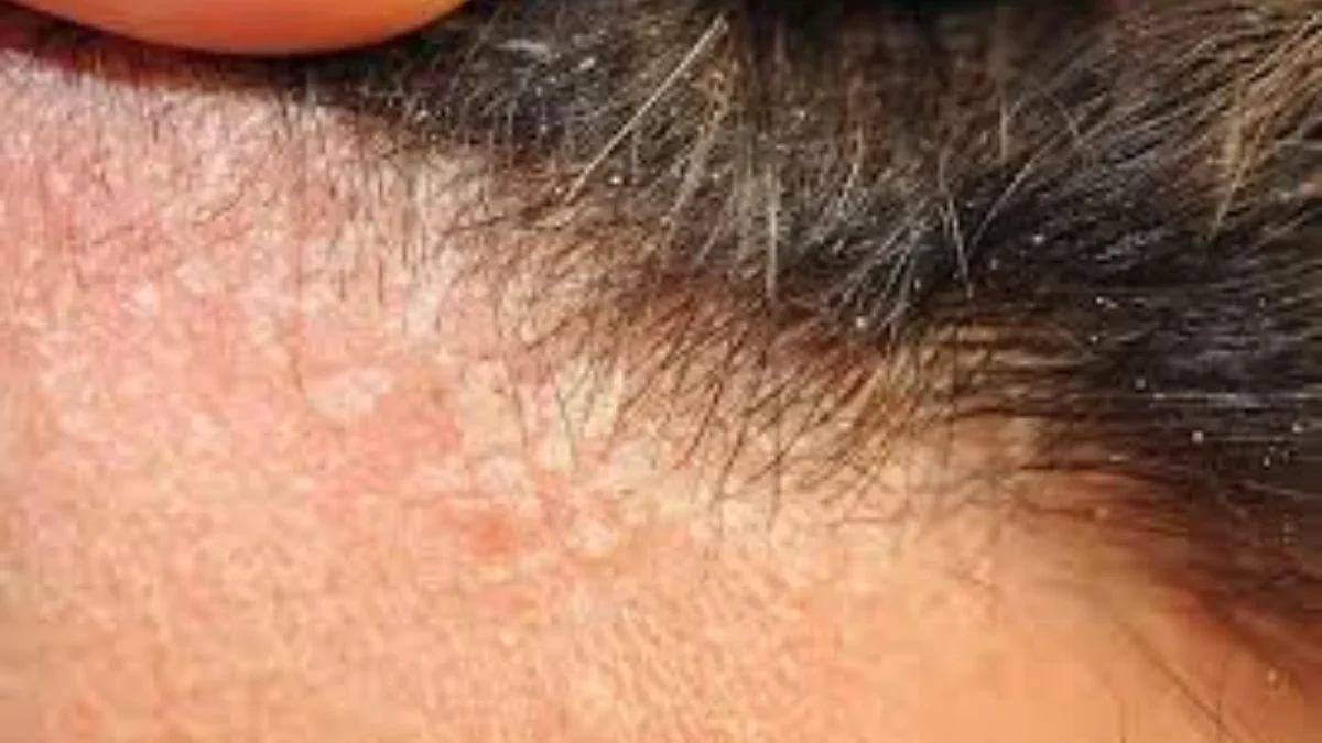 Ketombe atau Dermatitis Seboroik? Ini Cara Membedakannya!