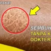 Cara Menghilangkan Sisik Putih Pada Kulit