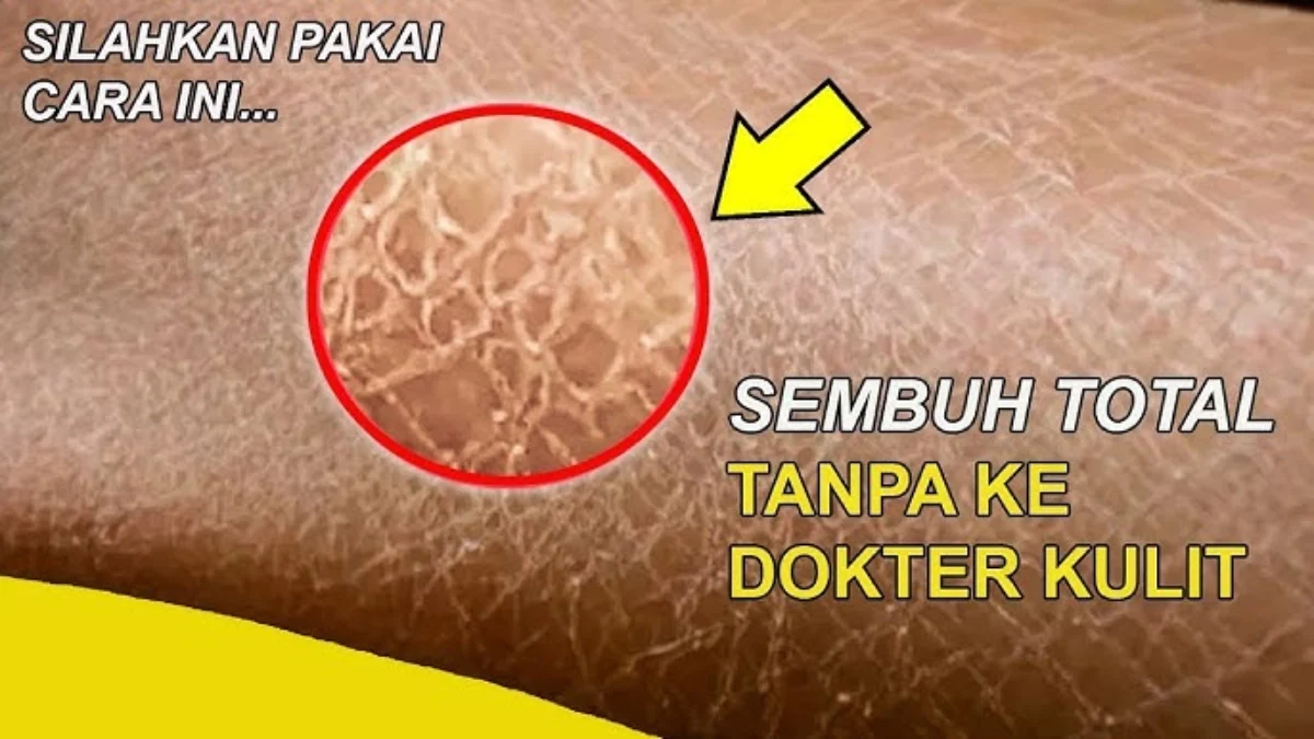 Cara Menghilangkan Sisik Putih Pada Kulit